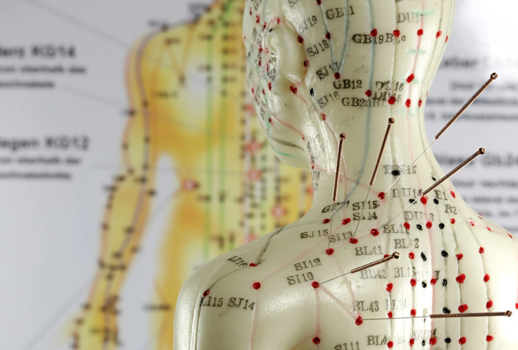 Acupuncture – how the traditional Chinese medicine (TCM) therapy can relieve pain and help your body